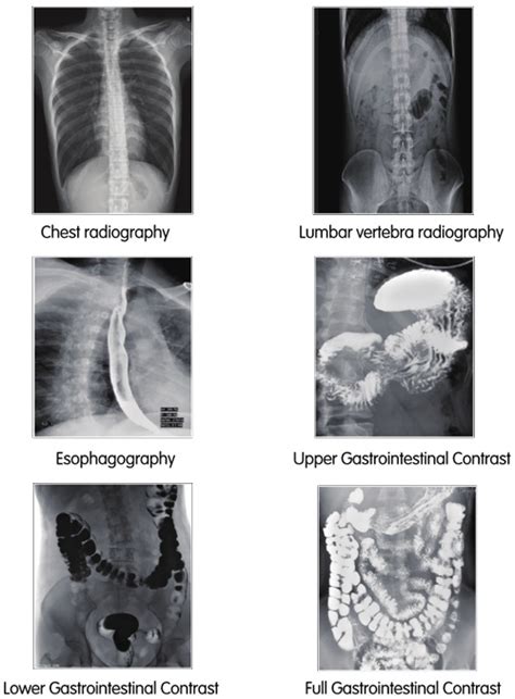 Hf Digital Radiography And Fluoroscopy System Pld9600a Perlove