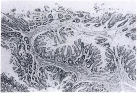 Polypoid adenoma of the cecum. Observe the central stalk composed of ...