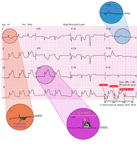 Anterior Stemi With Tombstone Morphology St Elevation Ecg | Porn Sex ...