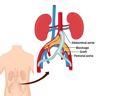 Aorta Femoral Bypass Surgery Vascular Expertise At Treatians