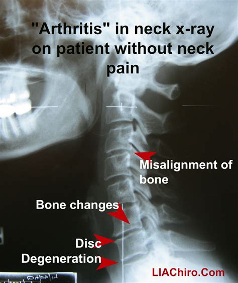 Neck pain's biggest myth