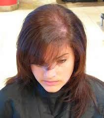 hair loss treatments: PCOS Hair Loss Treatment - Information You Need ...