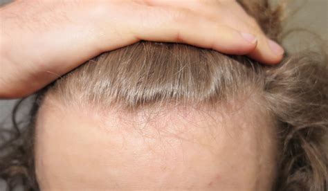 Seborrheic Dermatitis Hair Loss | Galhairs