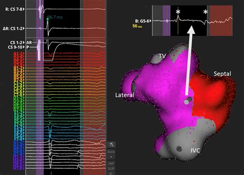 Typical Atrial Flutter Mapping And Ablation Cardiac Electrophysiology