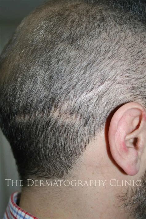 Hair Transplant Before And After Scar