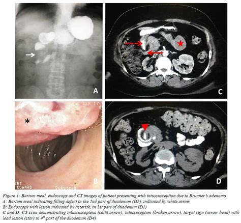 Duodeno Duodenal Intussusception Secondary To A Brunners Gland Adenoma