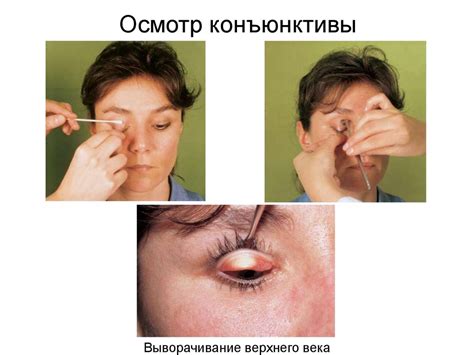 Воспалительные заболевания глаз и вспомогательного аппарата ...