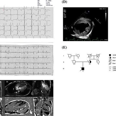 Echocardiogram Of The Patient During Follow Up Download Scientific