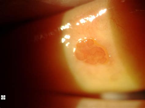 Sonoran Desert Eye Center Palpebral Conjunctival Papilloma Vs Granuloma