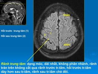 bs phan chau ha giai phau mri  naopdf