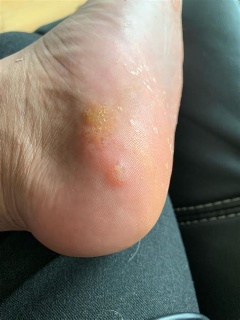 Bumps On My Foot What Is This R DermatologyQuestions