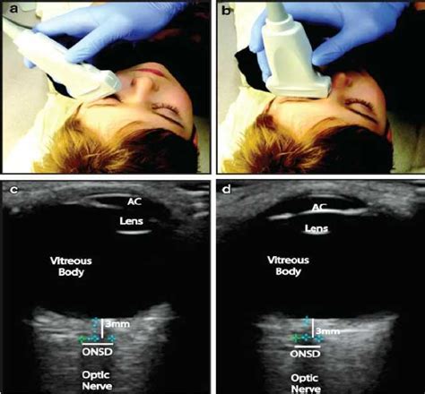 Korelasi Ct Scan Kepala Dan Ultrasonografi Selubung Saraf Optik Dengan