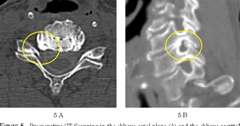 Figure 5 From Minimally Invasive Cervical Micro Endoscopic Foraminotomy