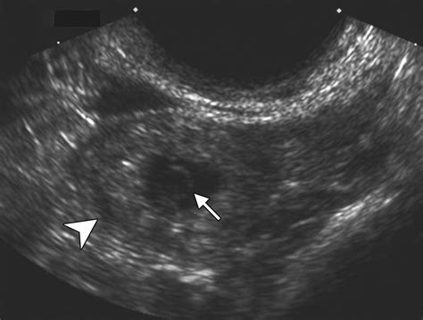 Diagnostic Clues To Ectopic Pregnancy Radiographics