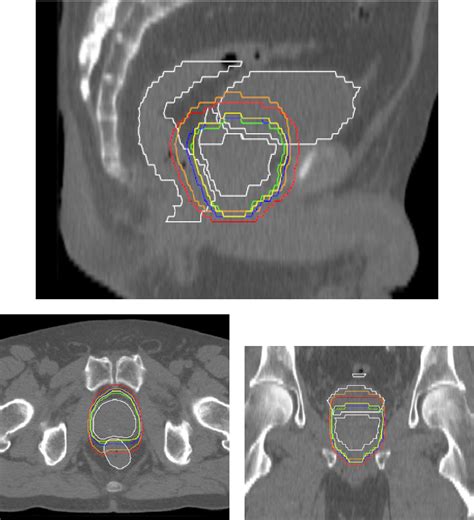 Figure From Radioth Rapie Guid E Par L Image Du Cancer De La