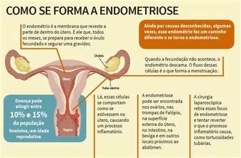 Endometriose o que é Vem saber tudo sobre essa doença Estilo Modas