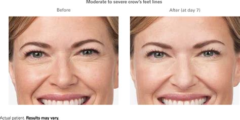 Crows Feet Before And After Botox Sciencehub