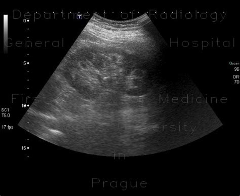 Radiology Case Medullary Nephrocalcinosis Calcification Of Medulla