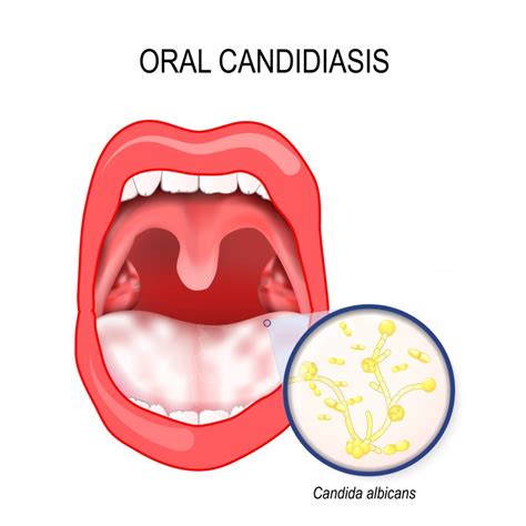 Oral Thrush Lips