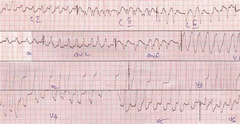 Afib With Rvr Treatment