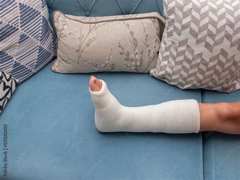 Broken Ankle And A Leg Cast Leg Splint Stock Photo Adobe Stock