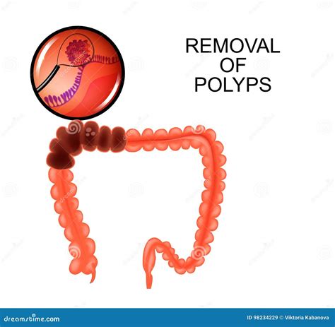 Polyps in the Colon. Removal of Polyps Stock Vector - Illustration of gastrointestinal ...