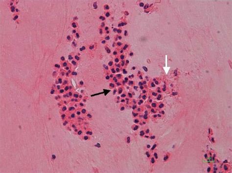 Haematoxylin And Eosin Stain ×40 Layers Of Degenerating Eosinophils