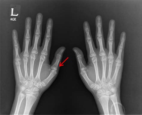 A Radiograph Of Both Hands Shows Opened Epiphyses Arrow In The Wrist