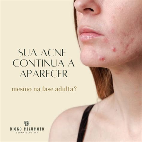 Cicatrizes De Acne Tratamento Dermatologista