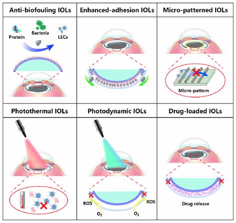 Schematic Illustration Of The Main Types Of Iols Used For Pco