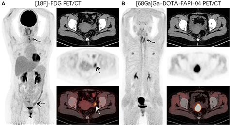 Frontiers 68Ga DOTA FAPI 04 PET CT As A Promising Tool For