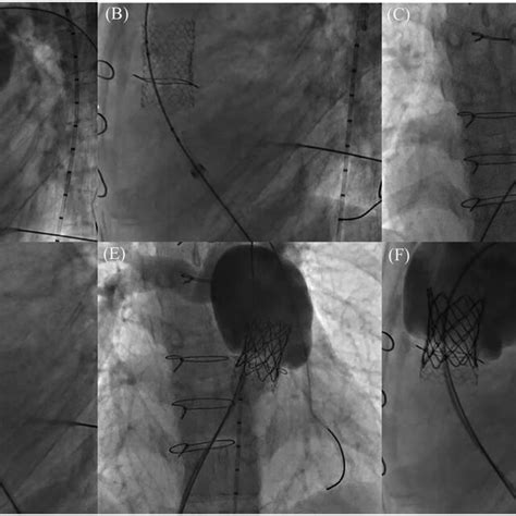 Medtronic Harmony Transcatheter Pulmonic Valve Reproduced With