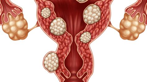 Fibrome utérin quand il faut opérer AlloDocteurs