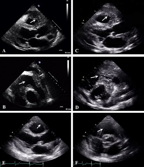 Severe Right Ventricular Outflow Tract Obstruction Caused By Non