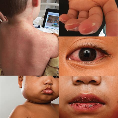 Kawasaki Disease Signs Symptoms And Diagnosis Empowered To Serve