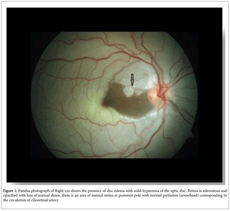 Central Retinal Artery Occlusion Anatomy