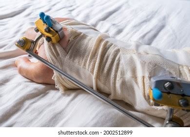 Wrist Injury After Surgery Broken Wrist Stock Photo 2002512899 ...