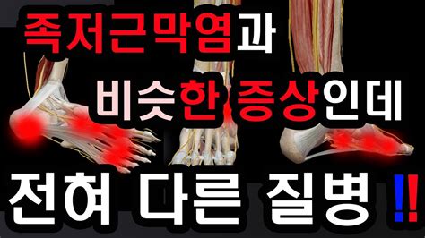 족저근막염에 대한 효과적인 최근치료법 발통증환자 필수영상 족저근막염 진단을 받은환자의 상당수가 다른 질병이 원인이다 족근관