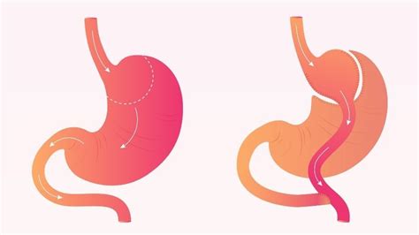 Gastric Bypass Surgery Cost Guide The More Clinics