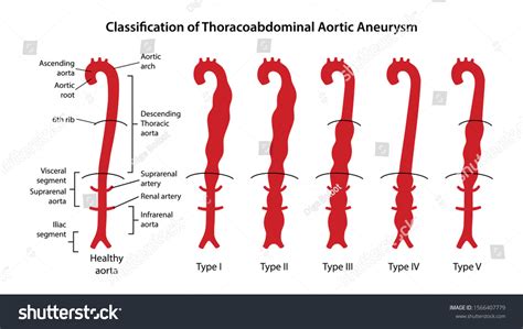 Vektor Stok Classification Thoracoabdominal Aortic Aneurysms Healthy