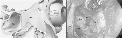 Ethmoid Lamina Papyracea On The Site