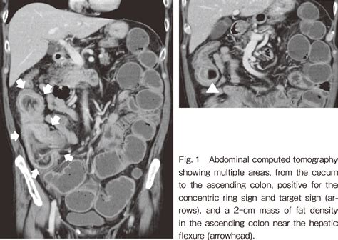 Figure 1 From Laparoscopic Ileocecal Resection For Strangulated Intestinal Obstruction