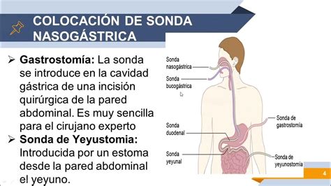 ColocaciÓn De Sonda NasogÁstrica NutriciÓn Enteral Y Lavado GÁstrico