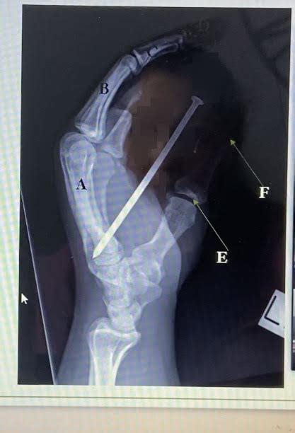 Hand Lateral In Flexion Diagram Quizlet