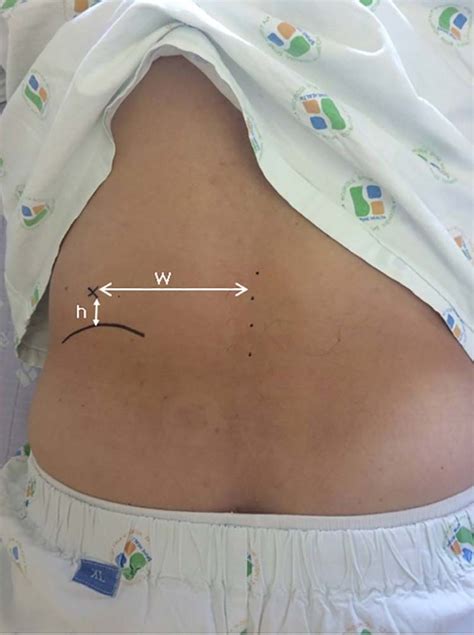 A Novel Preoperative Trajectory Evaluation Method For L5 S1