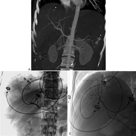 A Selective Left Renal Angiography Shows Active Extravasation Of Download Scientific Diagram