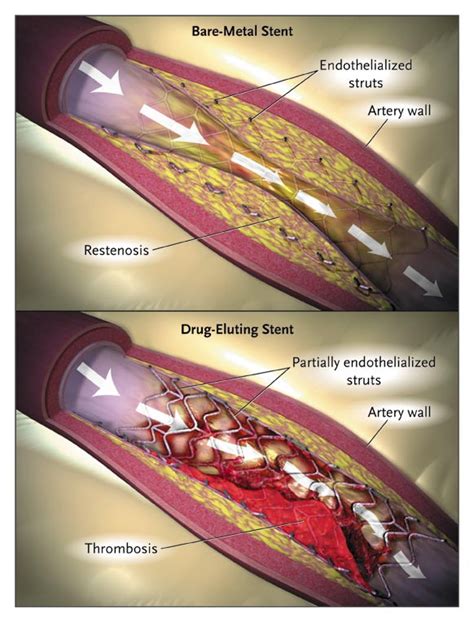 Drug Eluting Coronary Stents Promise And Uncertainty New England