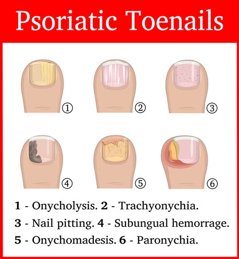 Nail Psoriasis - Ayurvedic Psoriasis Treatment