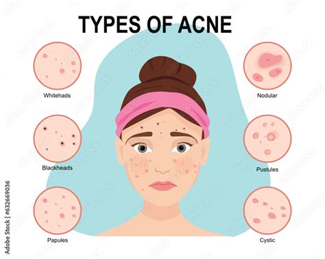 Types of acne. Skin problems Stock Vector | Adobe Stock