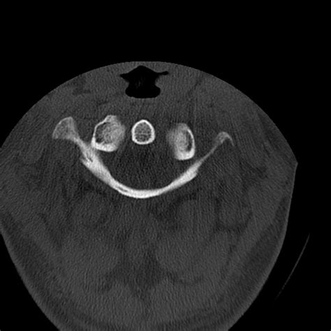 Occipital condyle fracture (Radiopaedia 31755-32691 Axial bone window ...